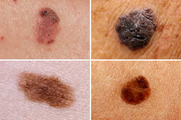 أنواع سرطان الجلد