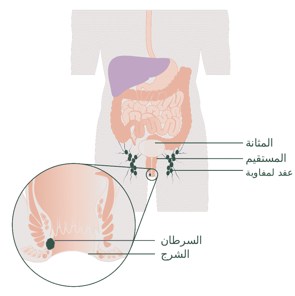 سرطان الشرج