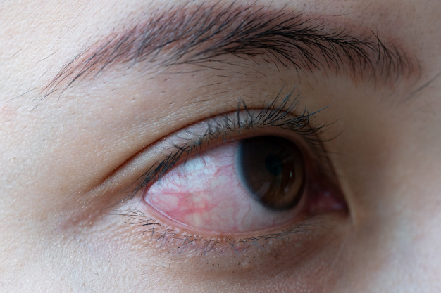 ستة أسباب تؤدي إلى احمرار العين يجب على الجميع معرفتها - طب فاكت