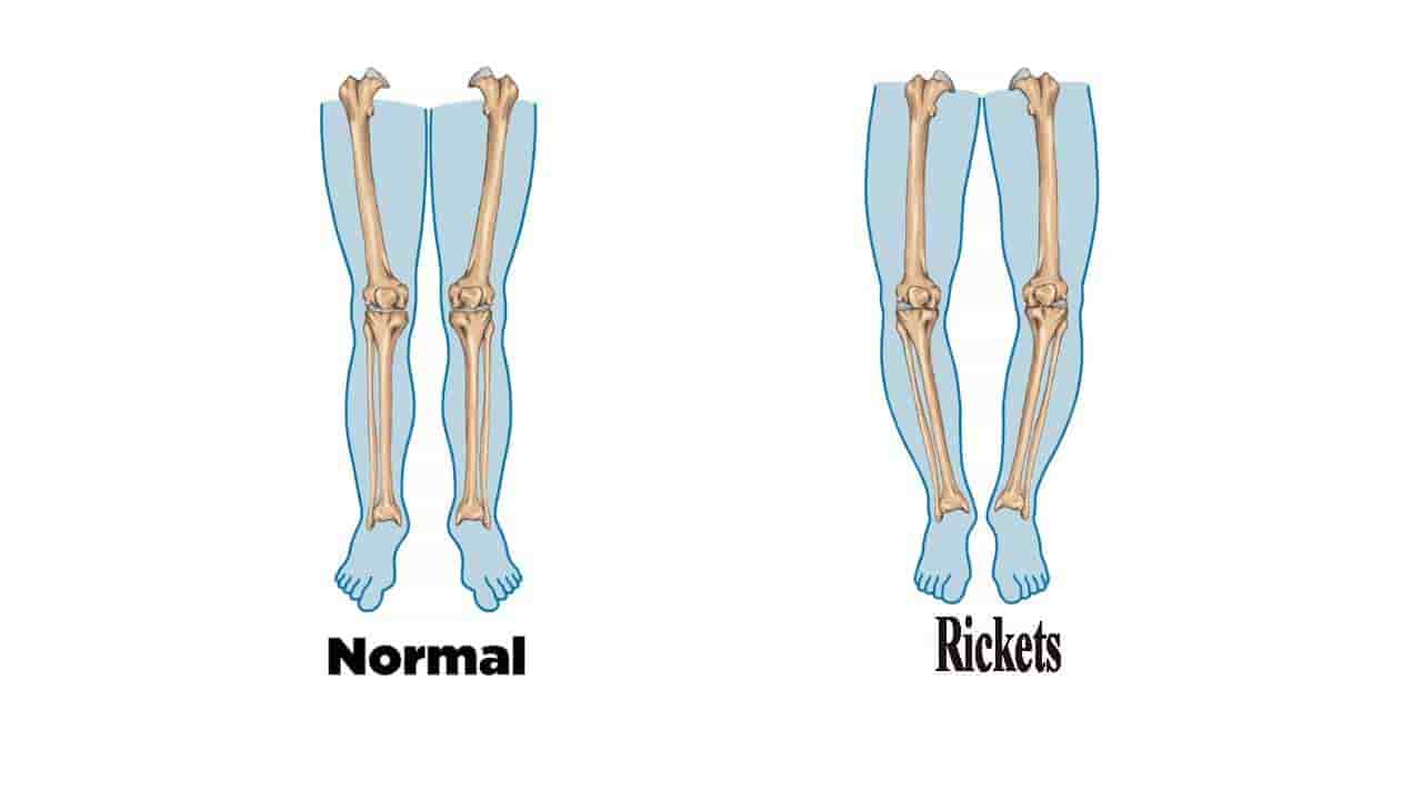 rickets