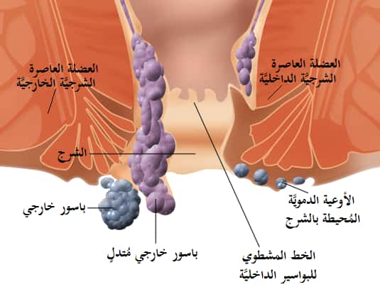 ما هي أعراض البواسير الداخلية عند الرجال؟  Dsvdedommel كوم