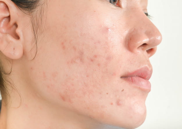 acne effects