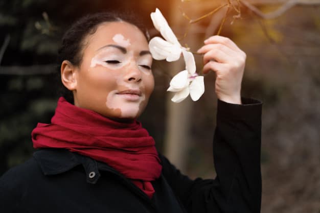 vitiligo treatment