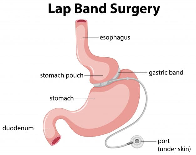 Gastric Banding